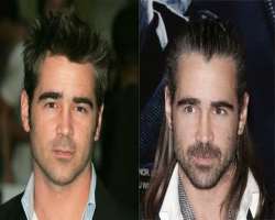 Colin Farrell before surgery